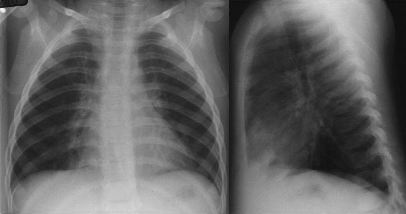 Interstitial pulmonary infltrate (Bronchopneumonia)